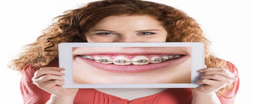 ارتودنسی ثابت و متحرک